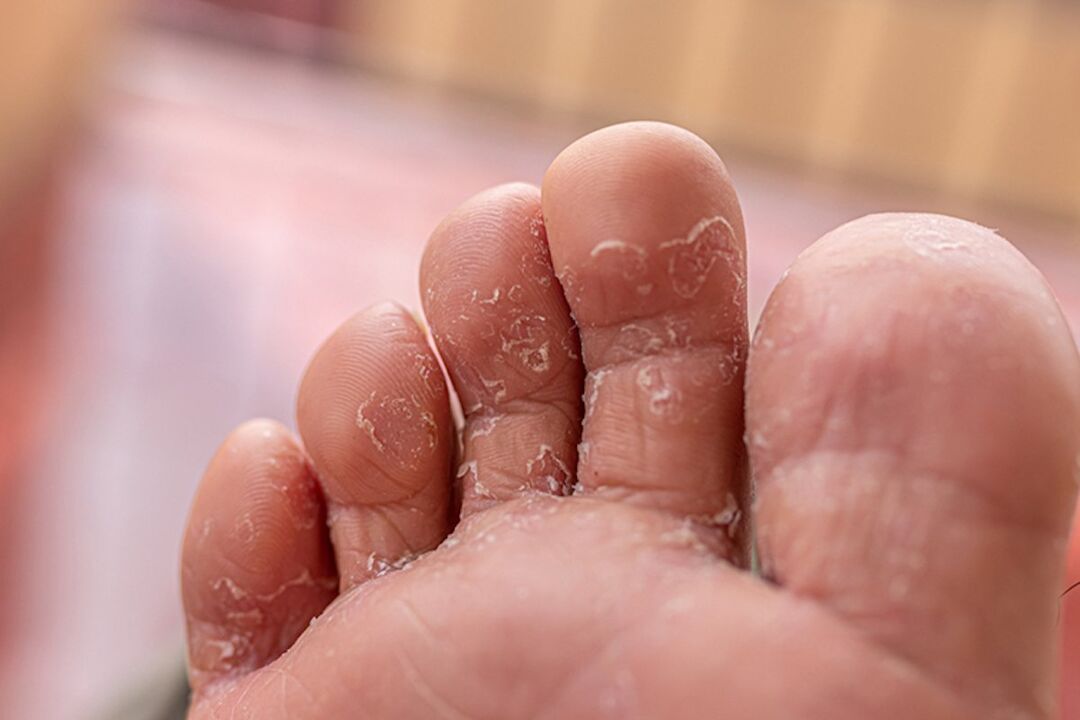 huba medzi prstami na nohách
