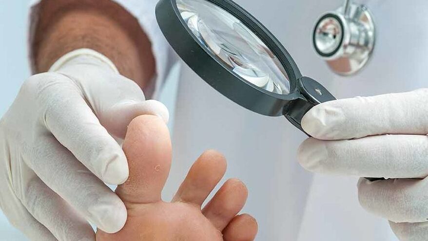 Diagnostiku plesní nechtov na nohách vykonáva dermatológ
