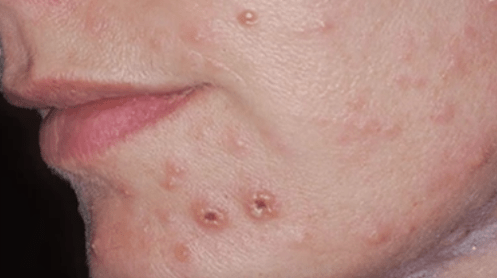 Plesňová infekcia kože na tvári