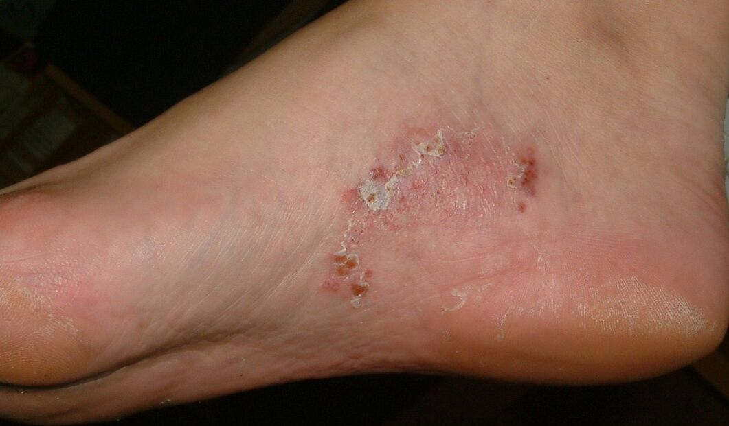 Prejavy plesňovej infekcie na nohe
